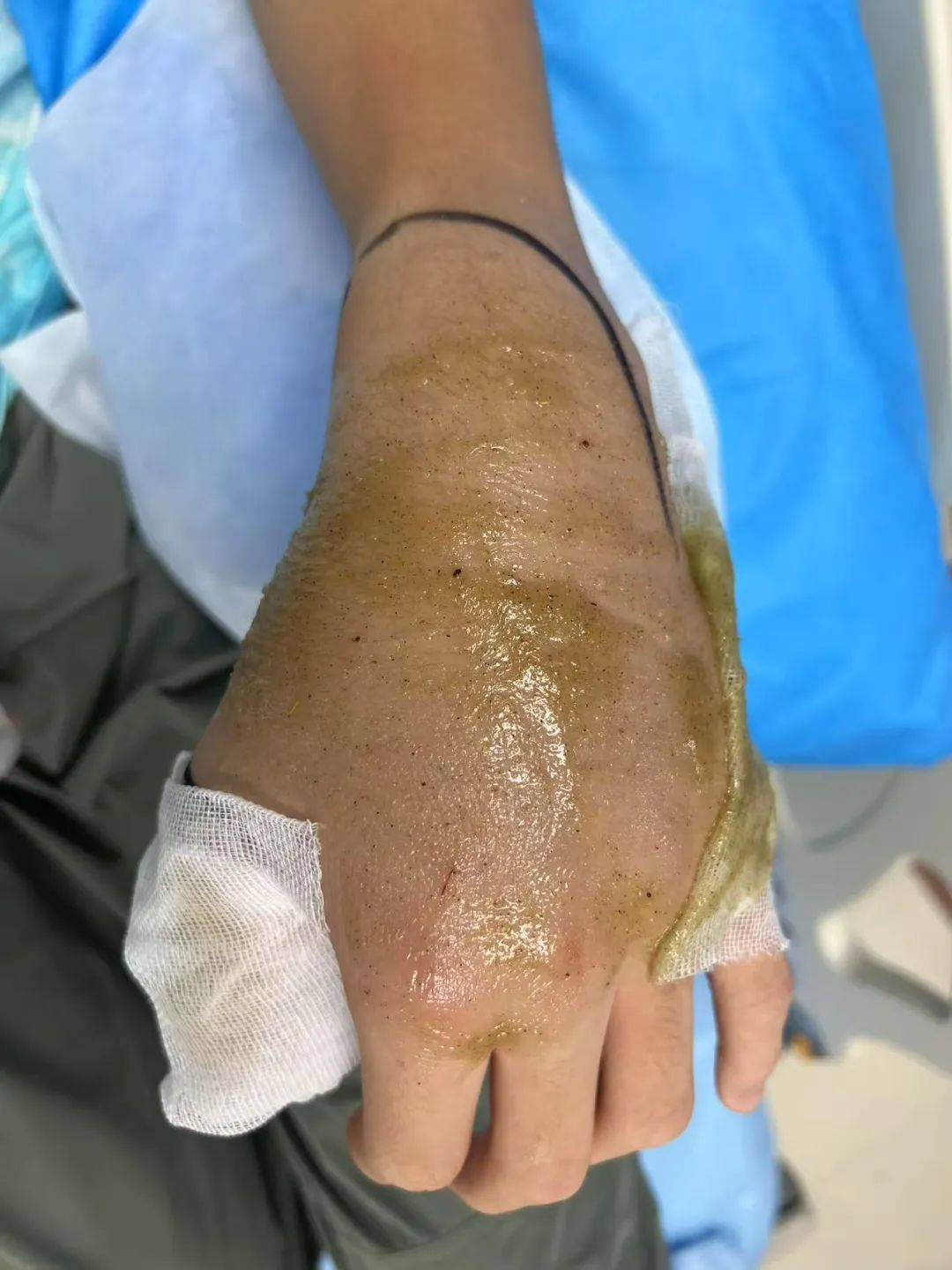 惊恐！毒蛇缠在自行车上，深圳13岁男孩伸手被咬！近期超80人中招