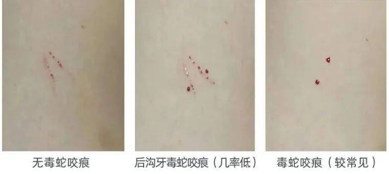 惊恐！毒蛇缠在自行车上，深圳13岁男孩伸手被咬！近期超80人中招