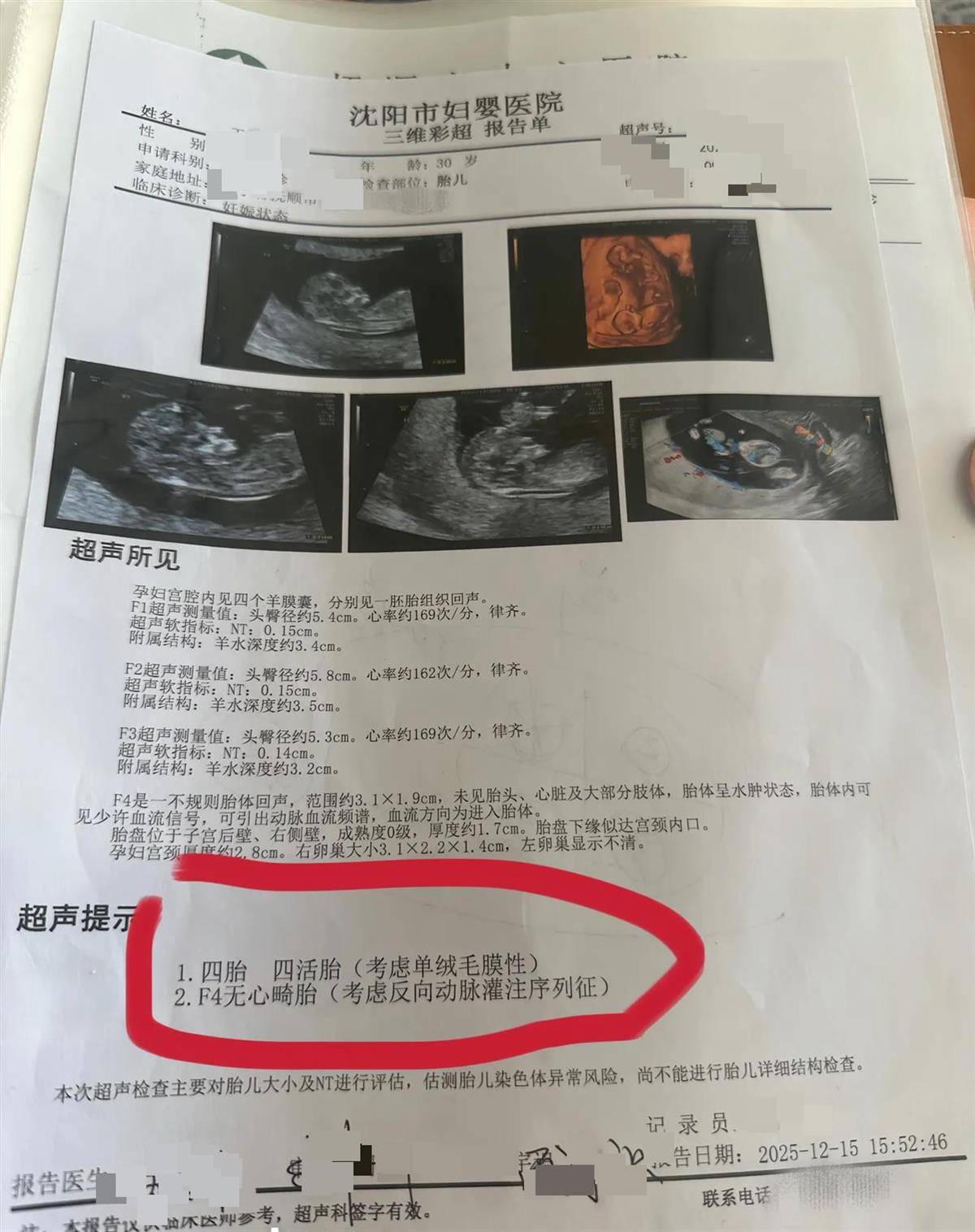 辽宁一孕妇两个月内从一胎变四胞胎,每次产检发现多出一胎,医生:系同卵四胞胎,概率1300万至1500万分之一